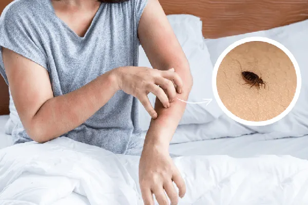 bed bugs itchiness this summer